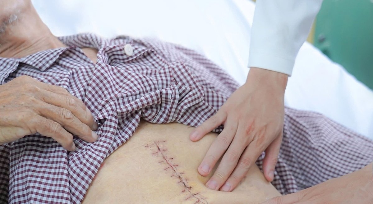 Phẫu thuật cấp cứu loại bỏ khối phình động mạch chủ nguy hiểm